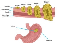 Como se produce el cancer de estomago