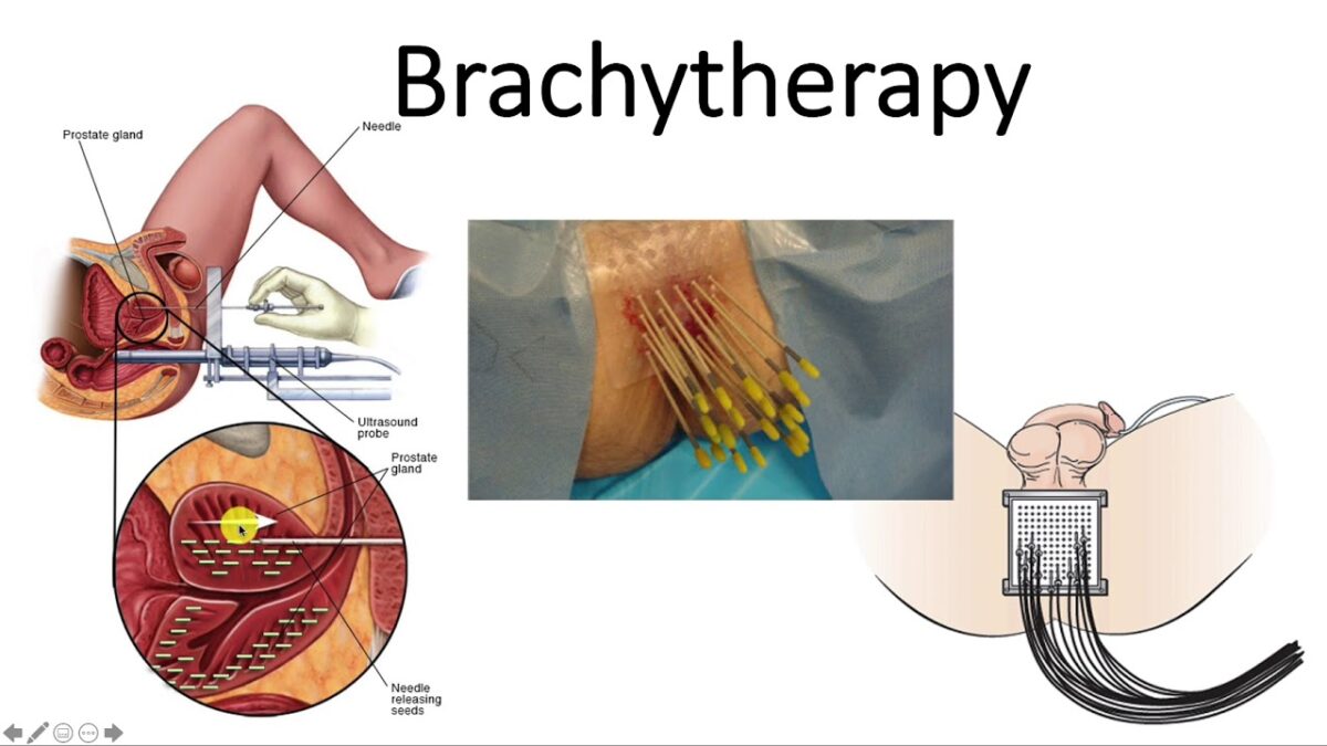Brachytherapy For Prostate Cancer Treatmentinus Com